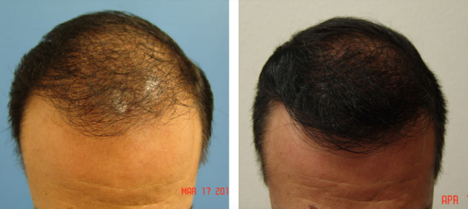 Before and After Hair Transplant 
