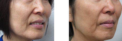 Before and After Fractional Resurfacing
