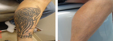 Before and After Laser Tattoo Removal