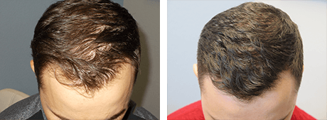 Before and After PRP Scalp Injections