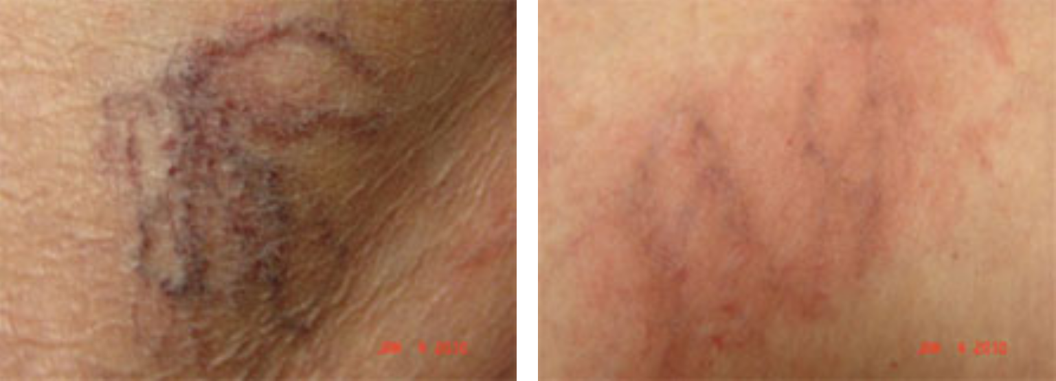 Before and After Sclerotherapy
