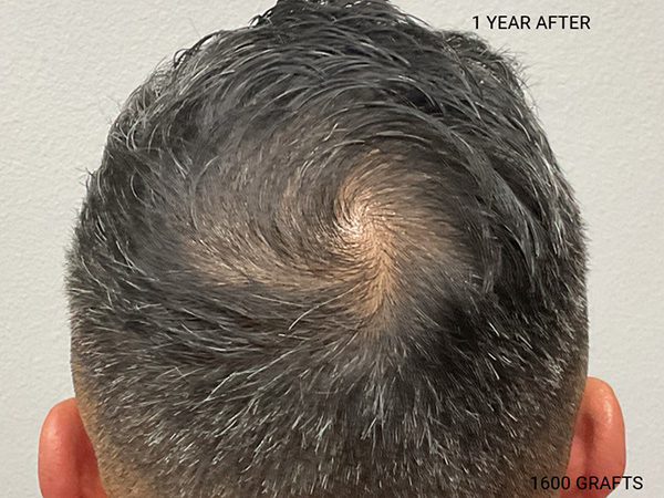 Hair Transplant