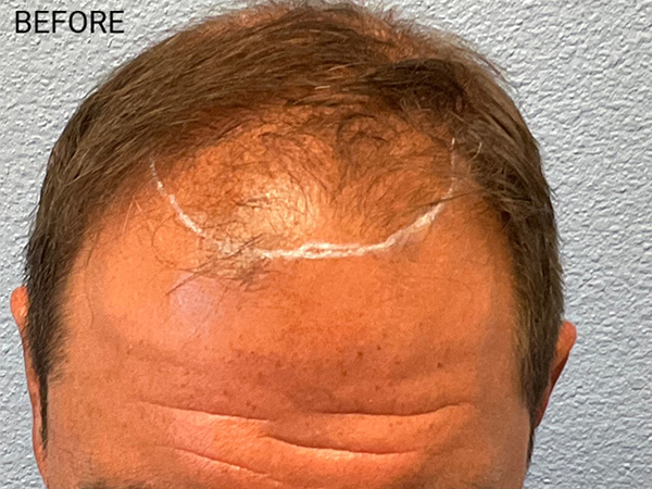 Hair Transplant