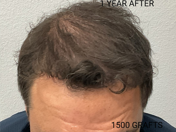 Hair Transplant