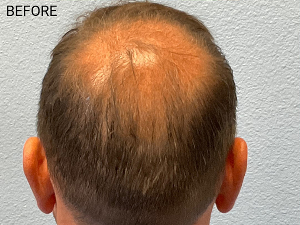 Hair Transplant