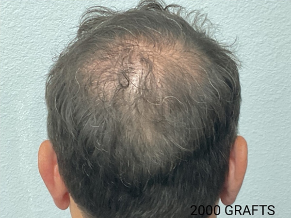 Hair Transplant