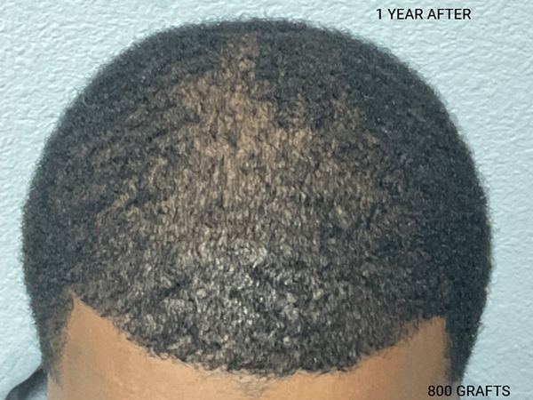 Hair Transplant