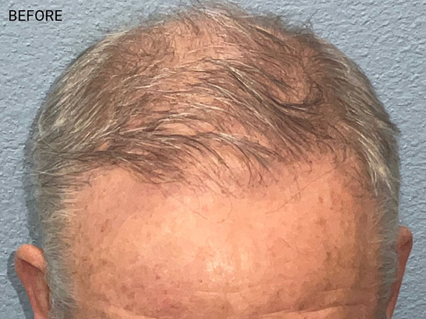 Hair Transplant