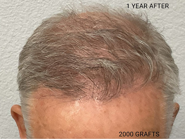 Hair Transplant