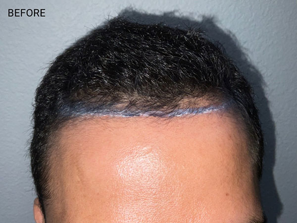 Hair Transplant