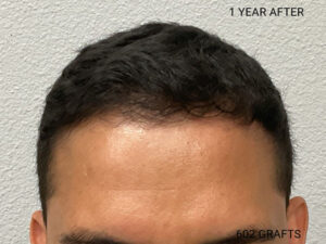 Hair Transplant