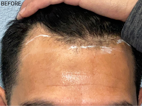 Hair Transplant