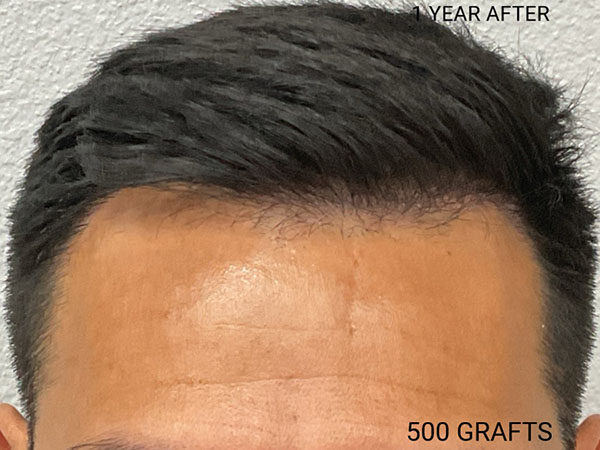 Hair Transplant