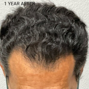 Hair Transplant