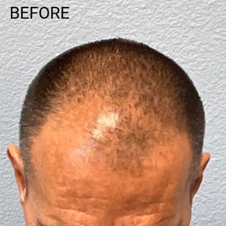 Hair Transplant