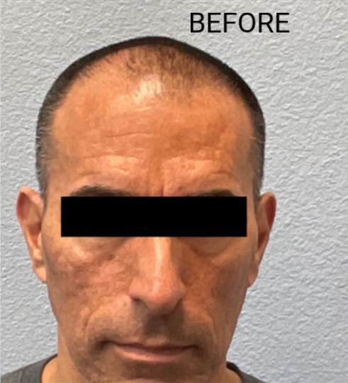 Hair Transplant