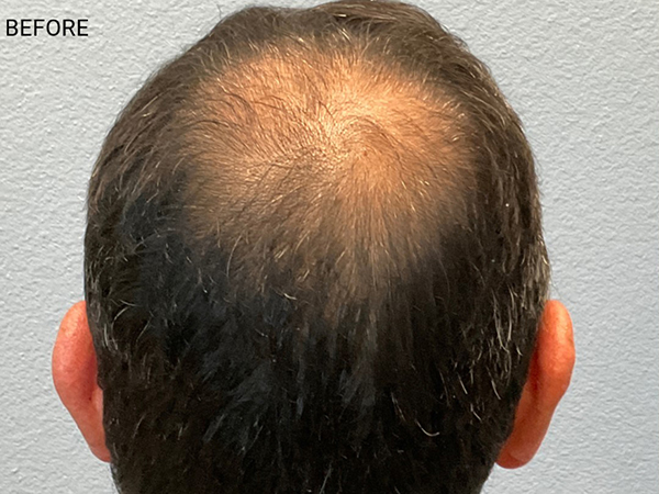 Hair Transplant