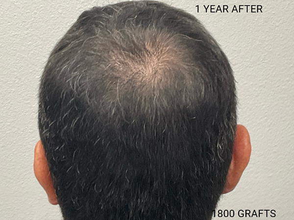 Hair Transplant