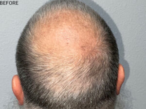 Hair Transplant