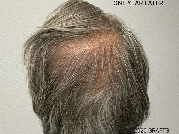 Hair Transplant