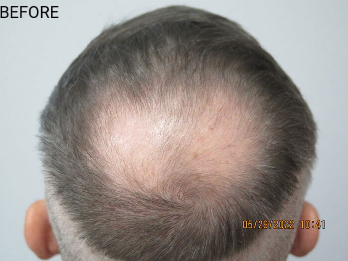 Hair Transplant