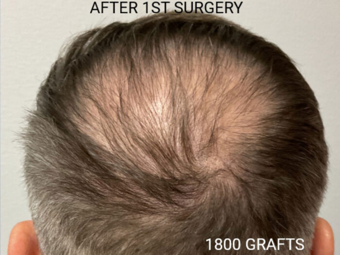 Hair Transplant