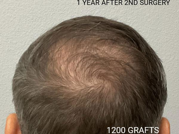 Hair Transplant