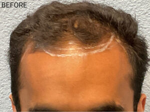 Hair Transplant