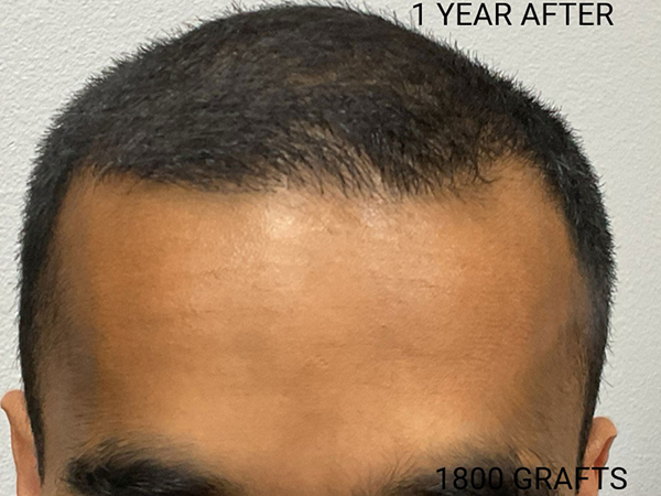 Hair Transplant