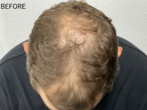 Hair Transplant