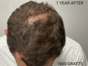 Hair Transplant