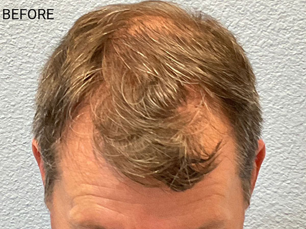 Hair Transplant