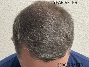 Hair Transplant