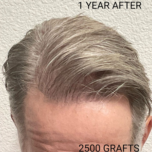 Hair Transplant