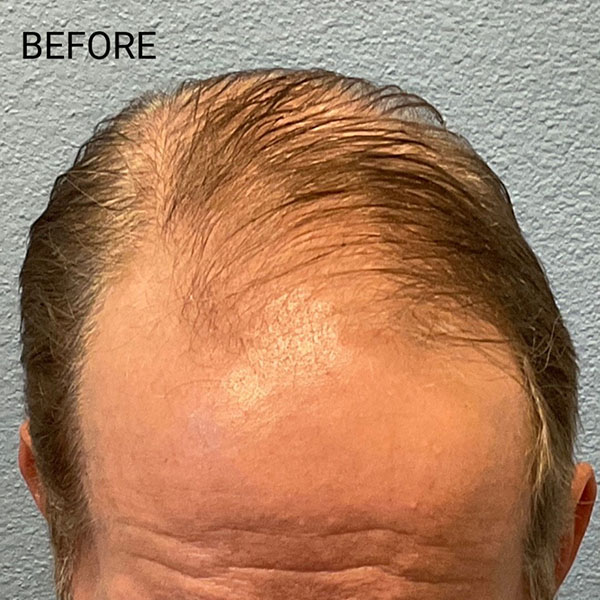 Hair Transplant