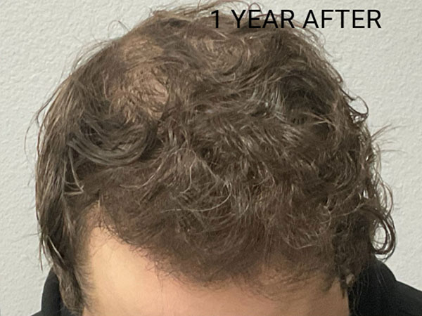 Hair Transplant