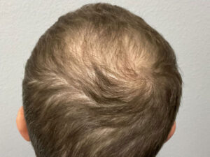 Hair Transplant