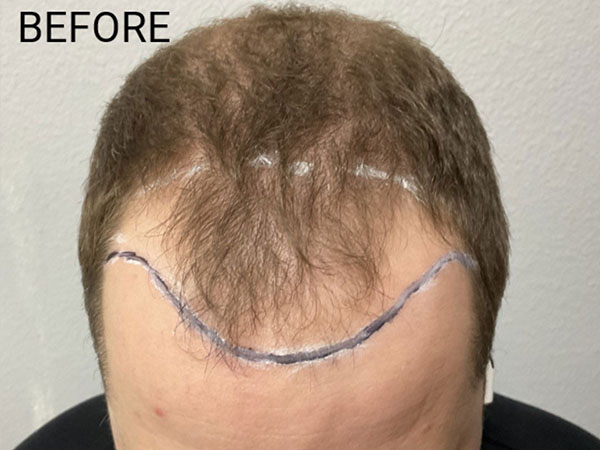 Hair Transplant