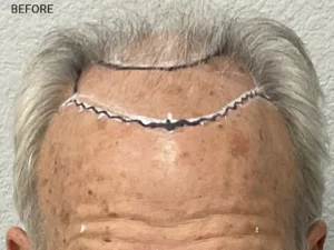 Hair Transplant