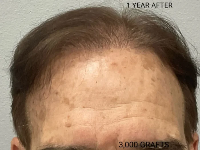 Hair Transplant