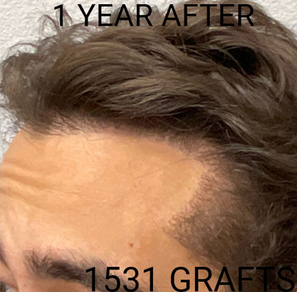 Hair Transplant