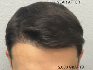 Hair Transplant