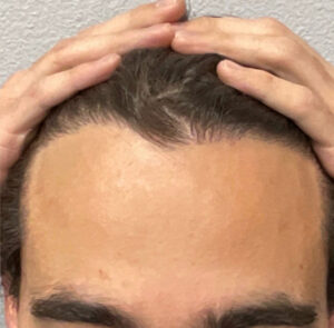 Hair Transplant