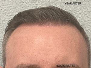 Hair Transplant