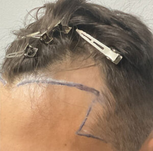 Hair Transplant