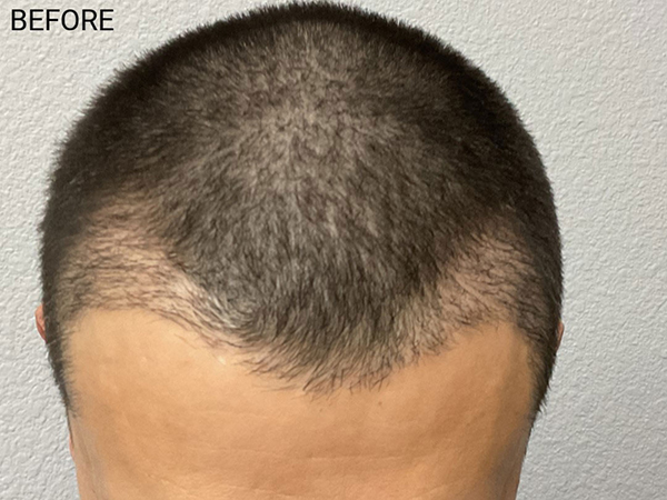 Hair Transplant