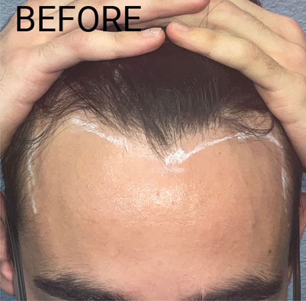 Hair Transplant