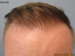 Hair Transplant