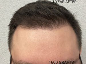 Hair Transplant