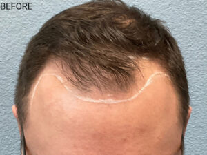 Hair Transplant